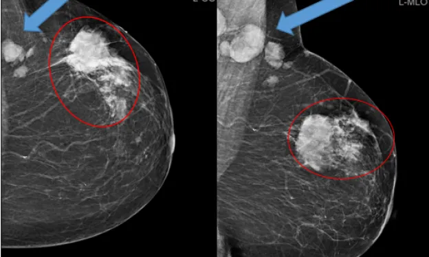 BI-RADS Category 5 Example Mammogram - MTMI