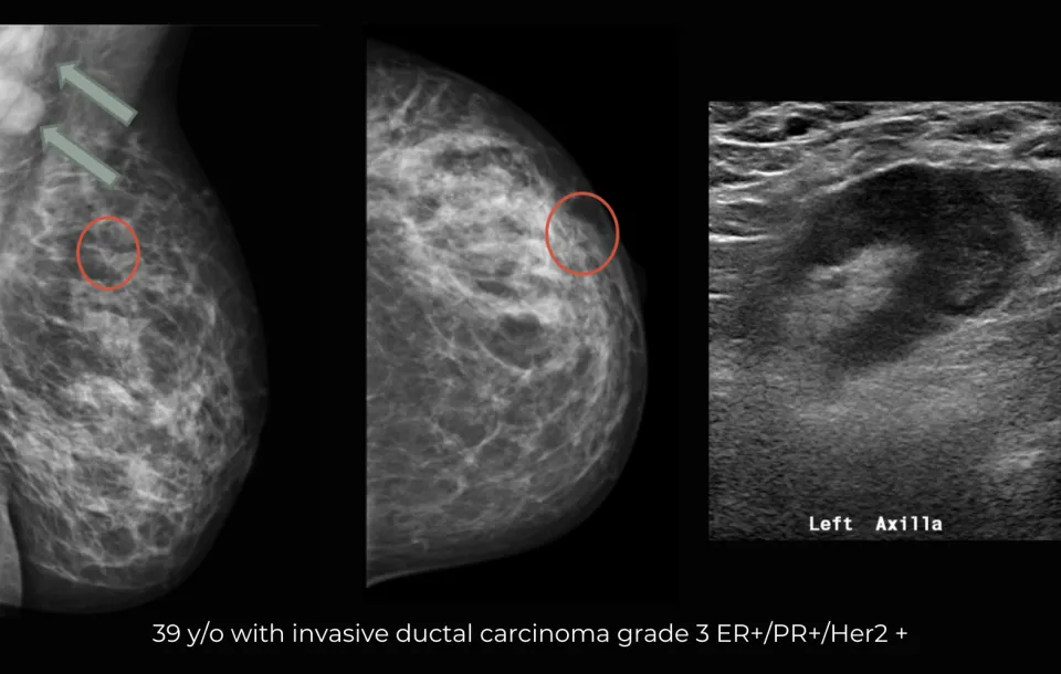 Breast Cancer Staging and Pathology for Mammographers Live Webinar