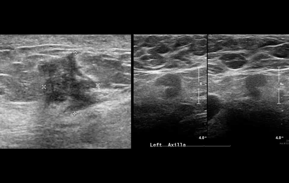 Breast Sonography Image Optimization Webinar