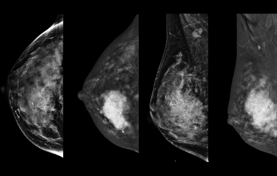 Contrast Enhanced Spectral Mammography (CESM) Webinar