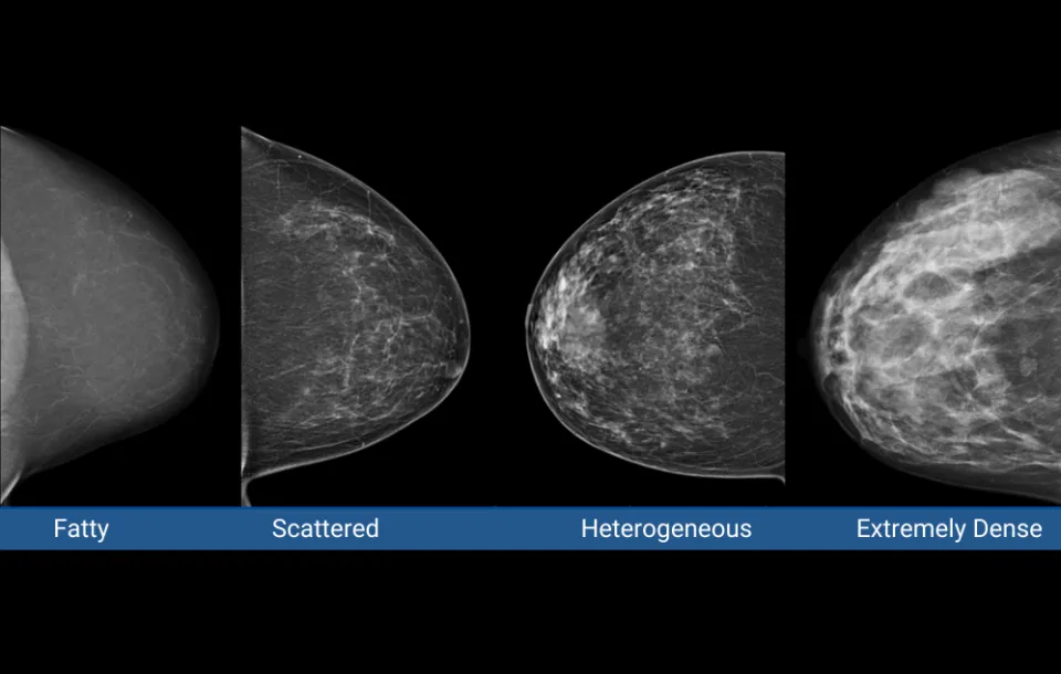 Understanding Dense Breasts: A Guide to Effective Imaging Choices 