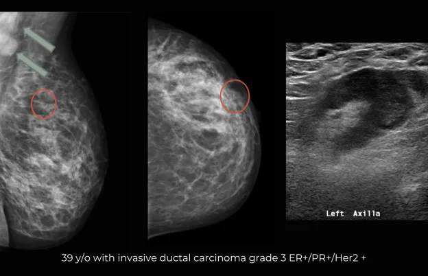 Breast Cancer Staging and Pathology for Mammographers