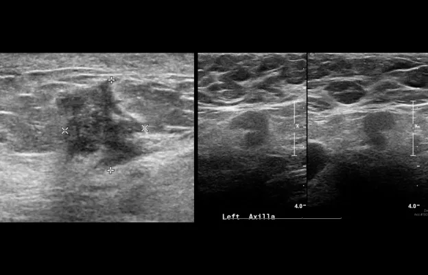 Breast Sonography Image Optimization