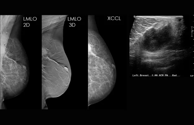 Advanced Mammography and Breast Ultrasound Correlation