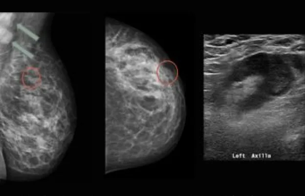 Breast Cancer Staging and Pathology for Mammographers