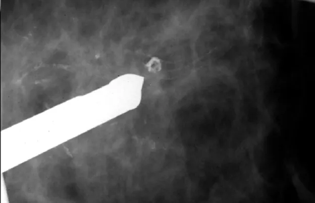 Breast Biopsy: Stereotactic and Ultrasound Guidance