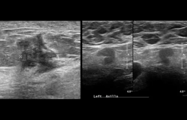 Breast Sonography Image Optimization