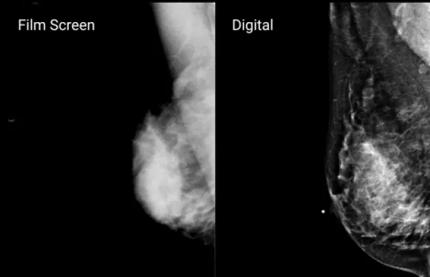 Digital Mammography 