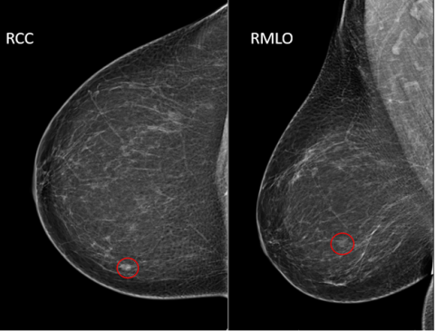 BI-RADS Category 0 Example Mammogram - MTMI