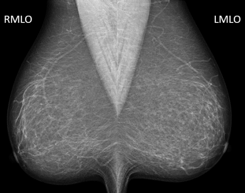 BI-RADS Category 1 Example Mammogram - MTMI