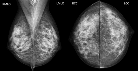 BI-RADS Category 2 Example Mammogram - MTMI