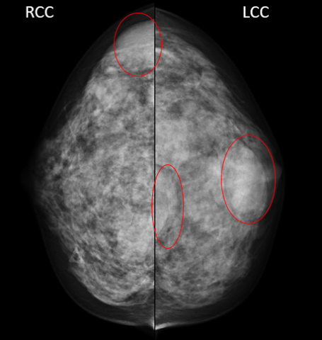 BI-RADS Category 3 Example Mammogram - MTMI