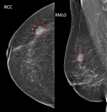 BI-RADS Category 4 Example Mammogram - MTMI