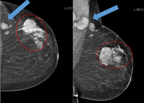 BI-RADS Category 5 Example Mammogram - MTMI