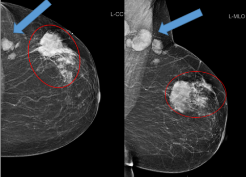 Breast mammogram shows Mass: What to do next