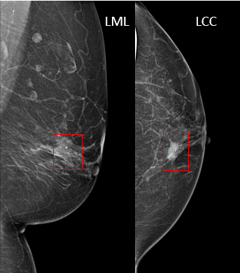 BI-RADS Category 6 Example Mammogram - MTMI